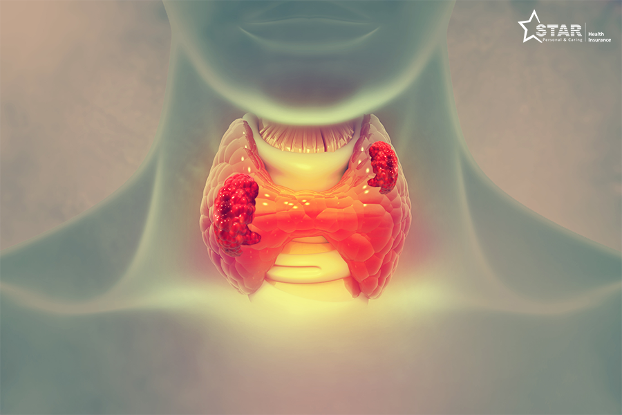 Health insurance for Throat Cancer