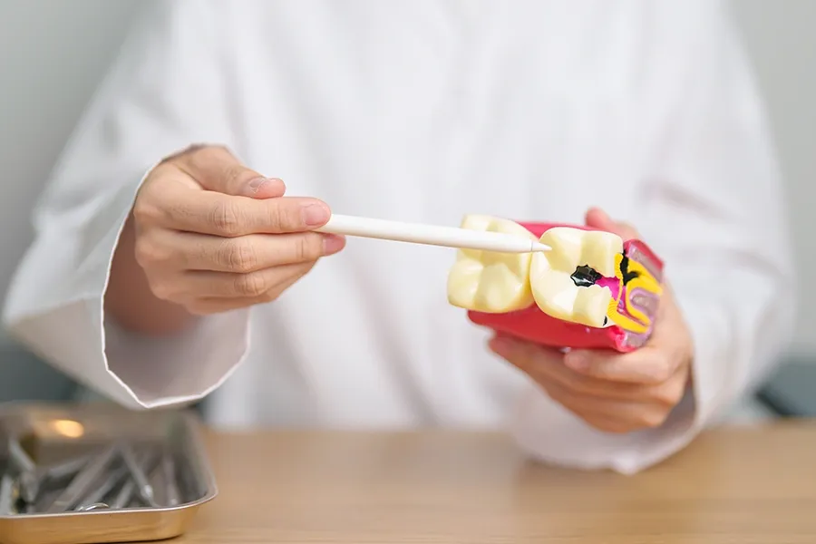 What are the Stages of Tooth Decay