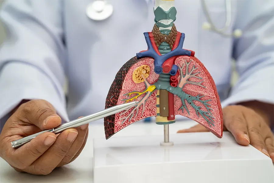 What are the Symptoms of Stage 1 Lung Cancer